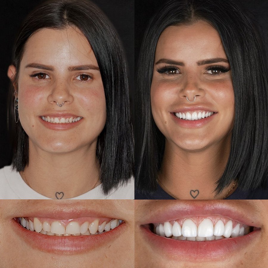 Smile Design with Porcelain Veneers