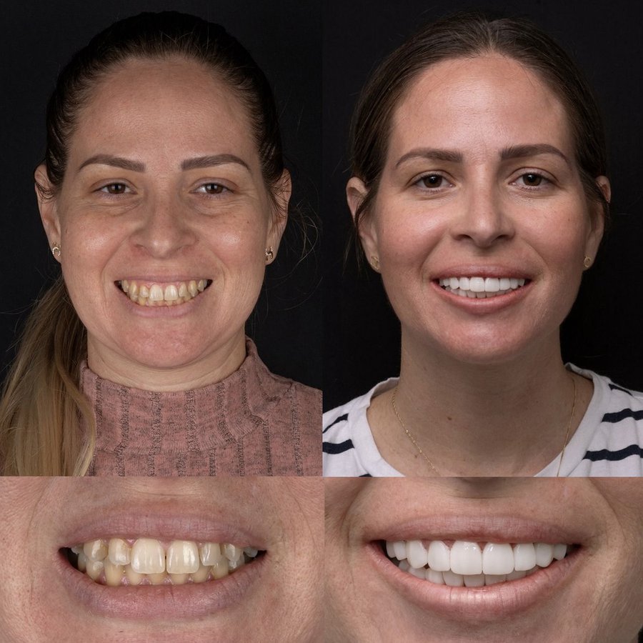 Smile Design with Porcelain Veneers