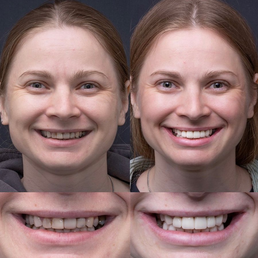 Smile Design with Porcelain Veneers