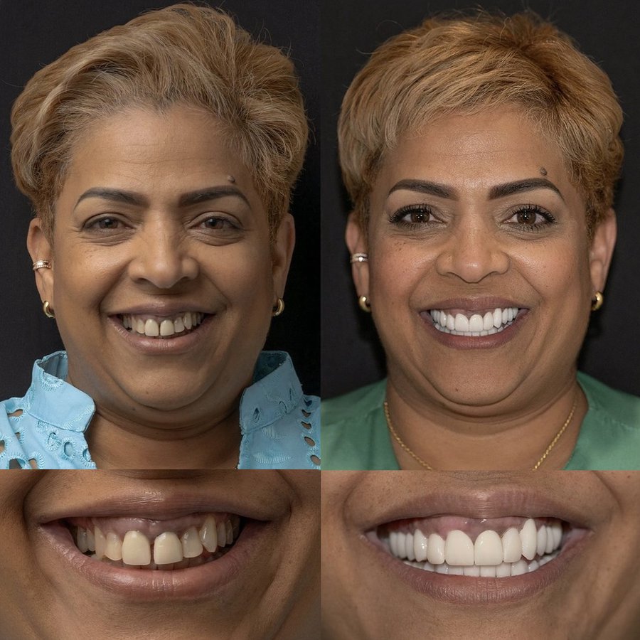 Smile Design with Porcelain Veneers
