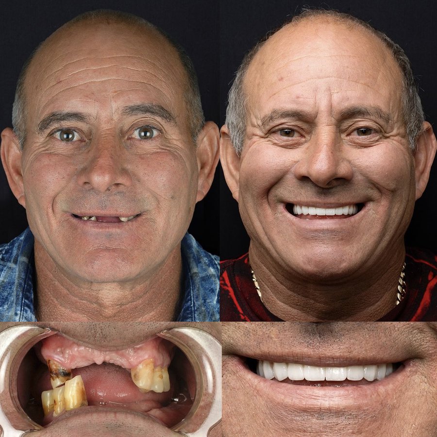 Hybrid Denture (top and bottom arch)