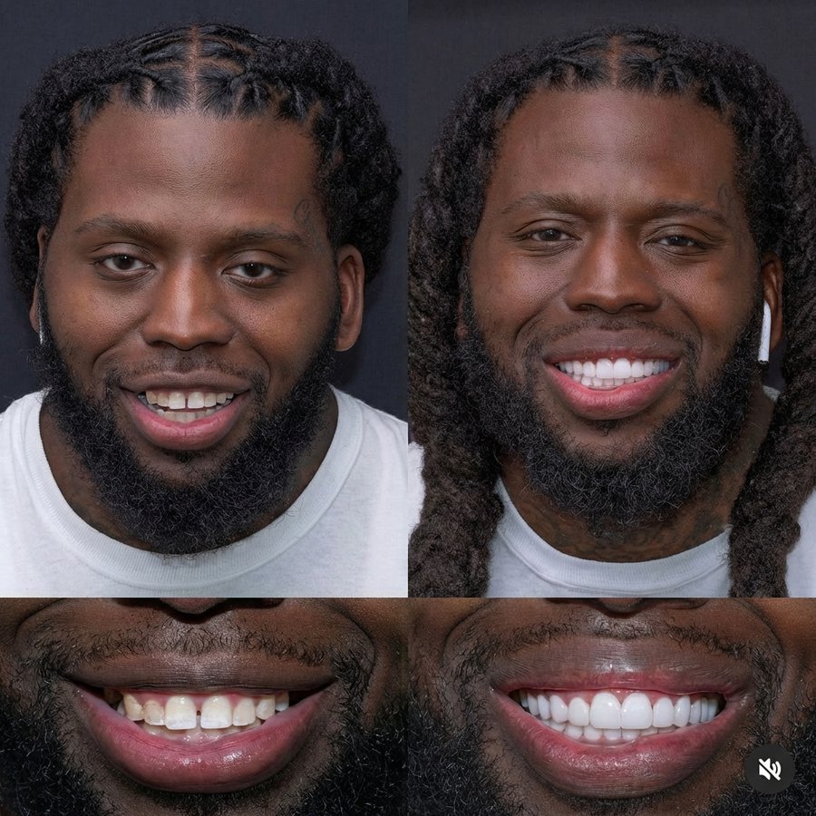 Smile Design with Porcelain Veneers