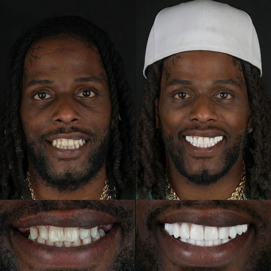 Smile Design with veneers, crowns and implants.