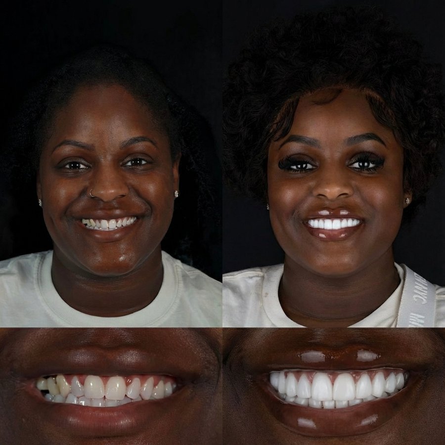 Smile design with Porcelain Veneers