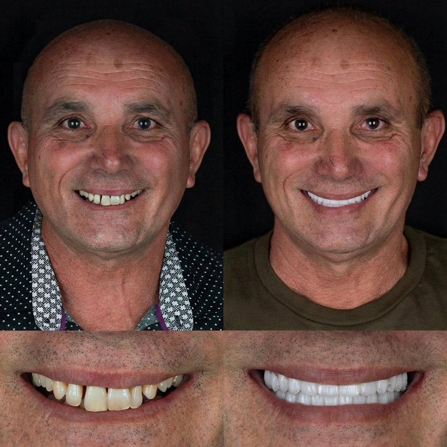 Hybrid Denture (top and bottom)