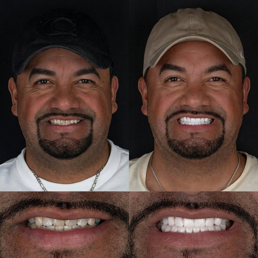 Smile design with Porcelain Veneers