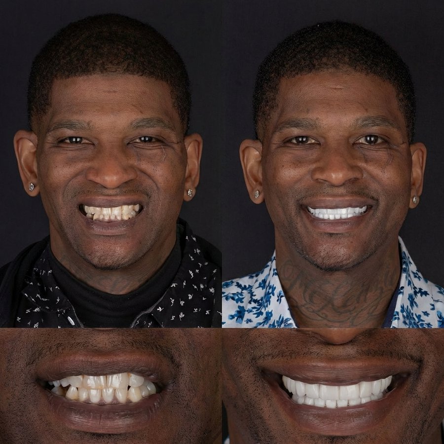 Smile design with Porcelain Veneers