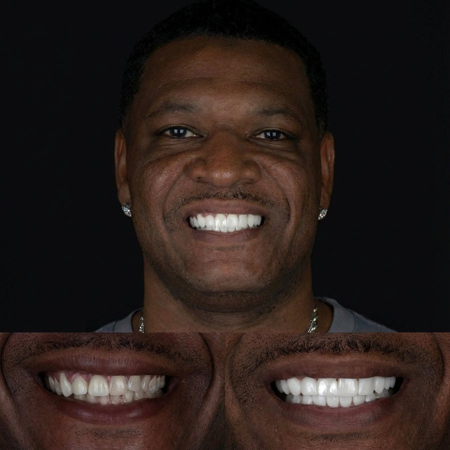 Smile design with Porcelain Veneers