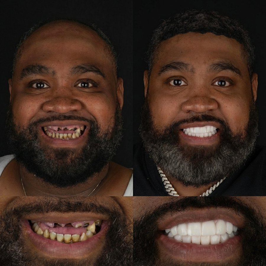 Hybrid Denture (top arch) Veneers (bottom arch)