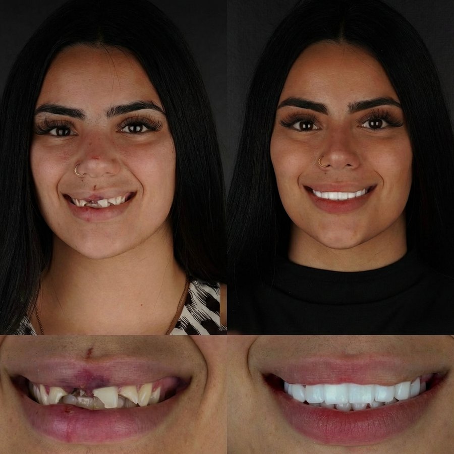 Smile design with Porcelain Veneers and Dental Bridge