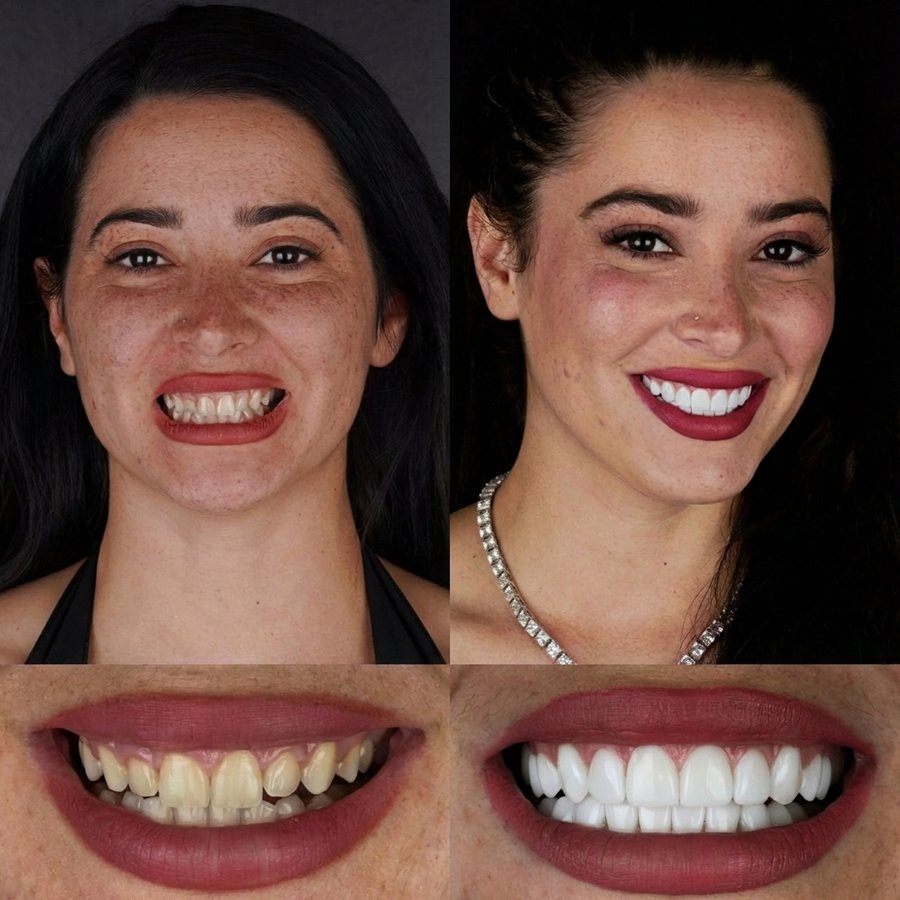 Smile design with Porcelain Veneers and gingivectomy