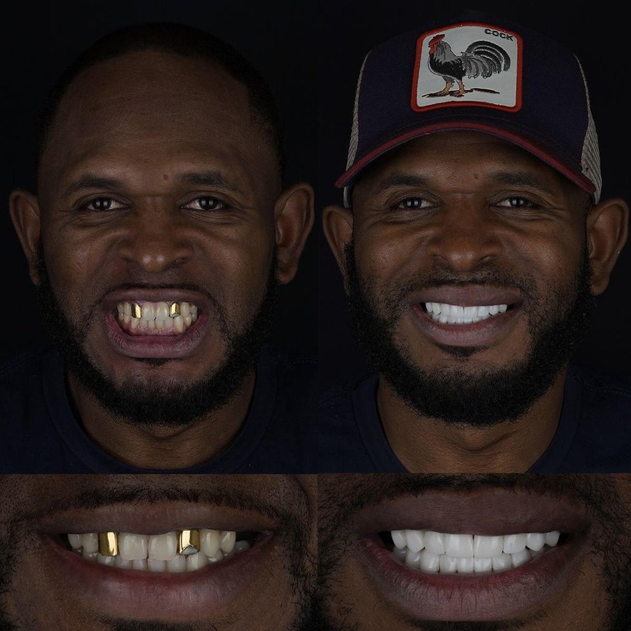 Smile design with Porcelain Veneers and Crowns