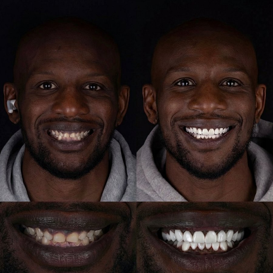 Smile design with Porcelain Veneers