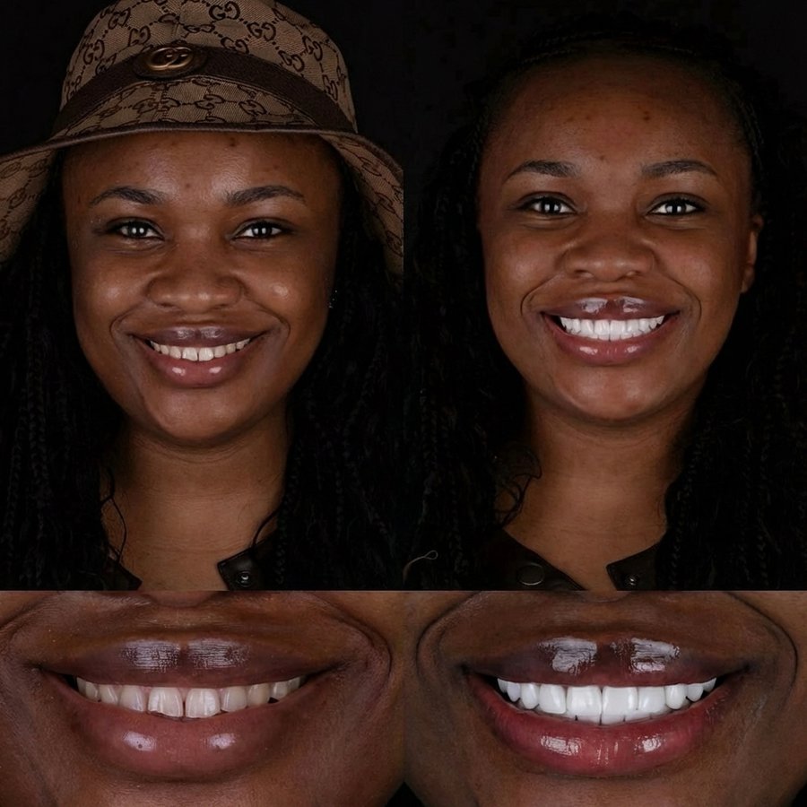 Smile design with Porcelain Veneers