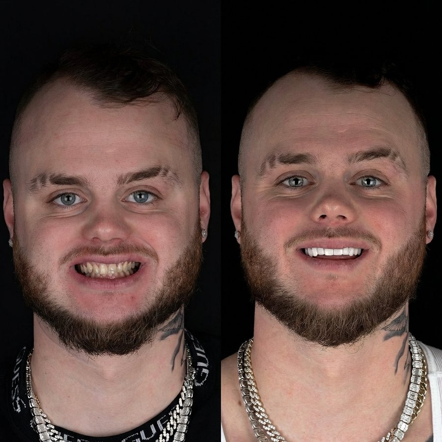 Smile design with Porcelain Veneers