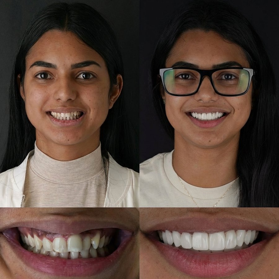Smile design with Porcelain Veneers