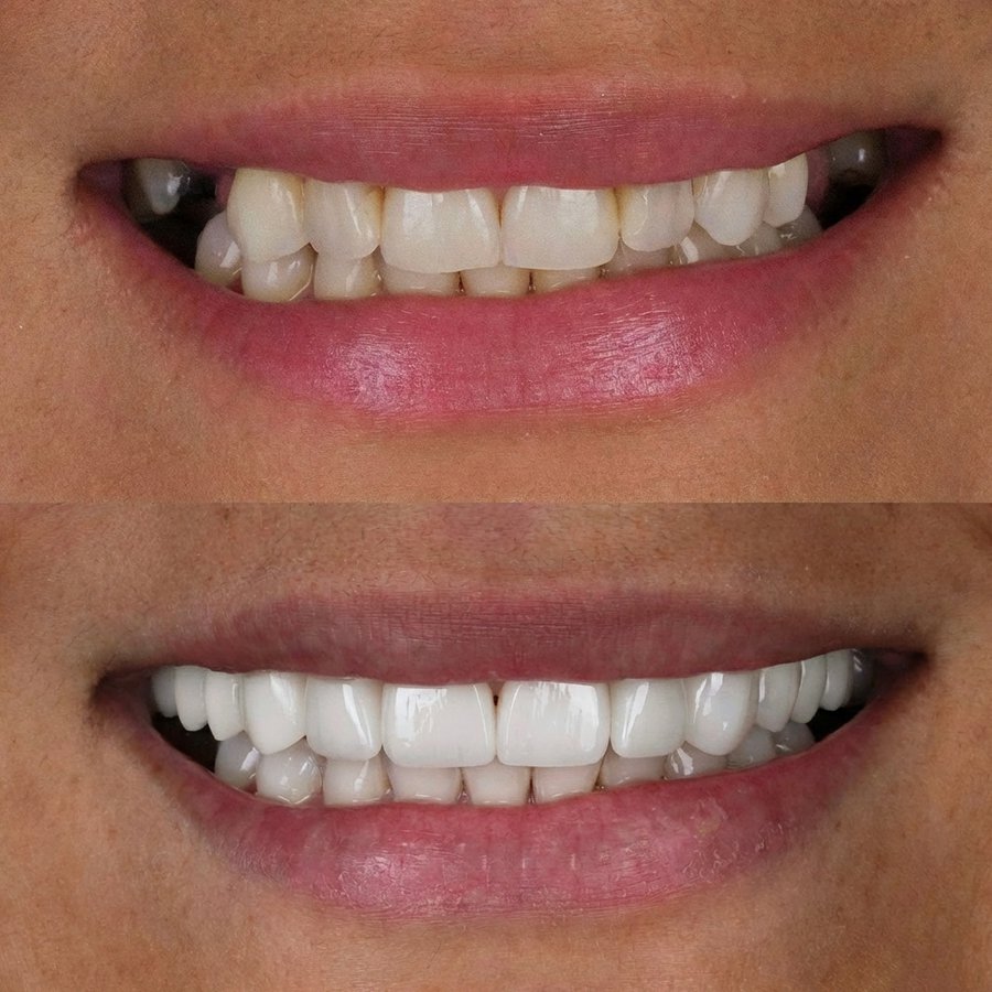 Smile design with Porcelain Veneers and Bridge