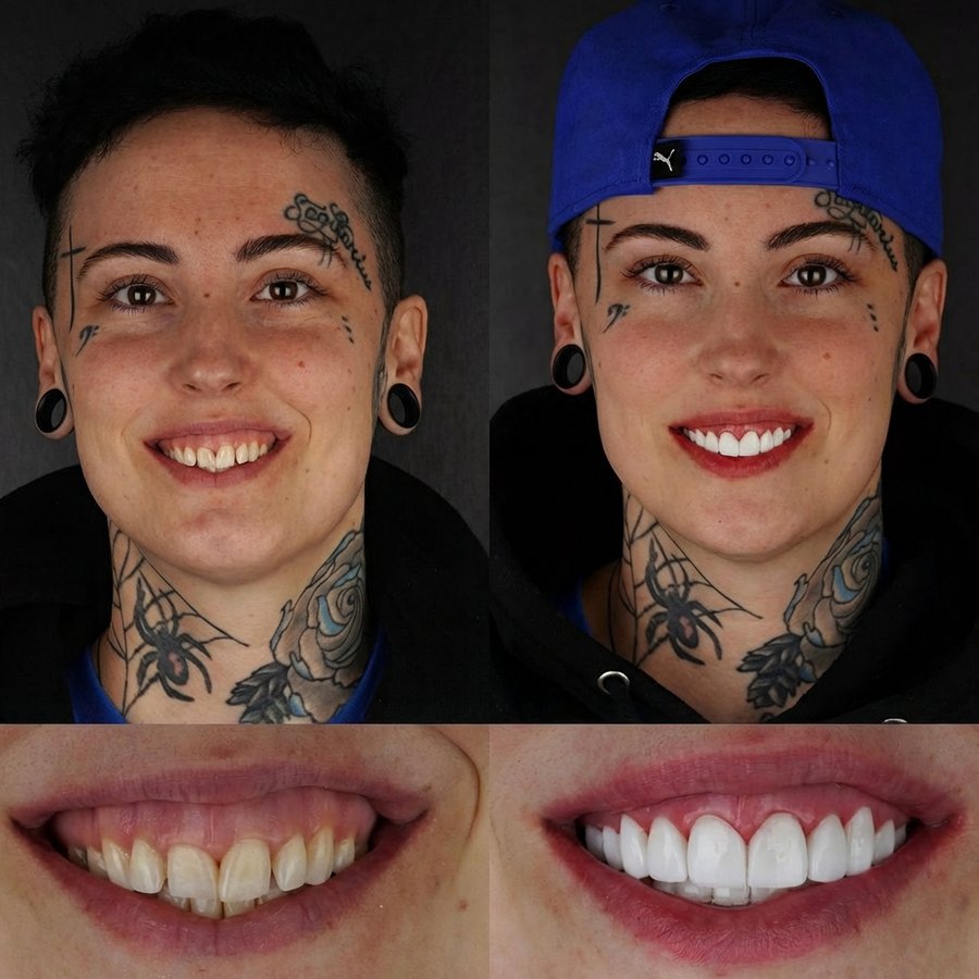 Smile design with Porcelain Veneers and Gingivectomy