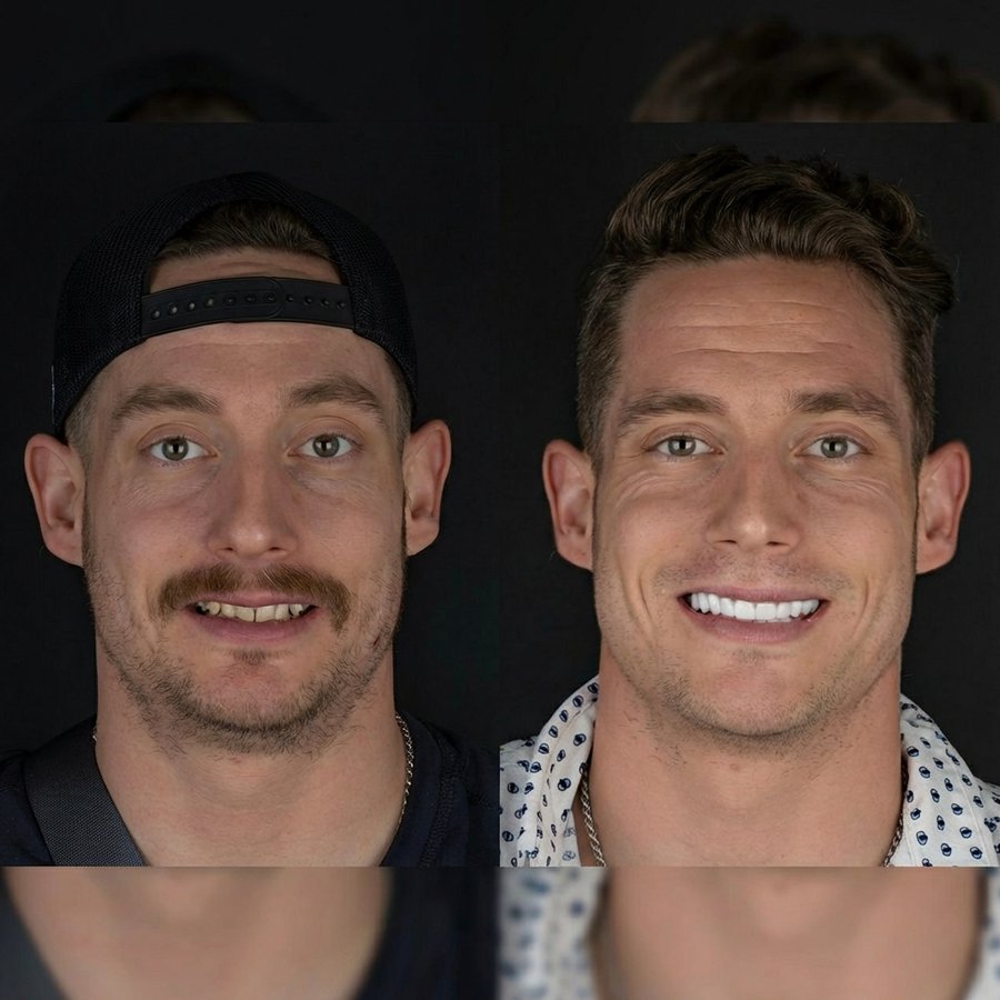 Smile design with Porcelain Veneers