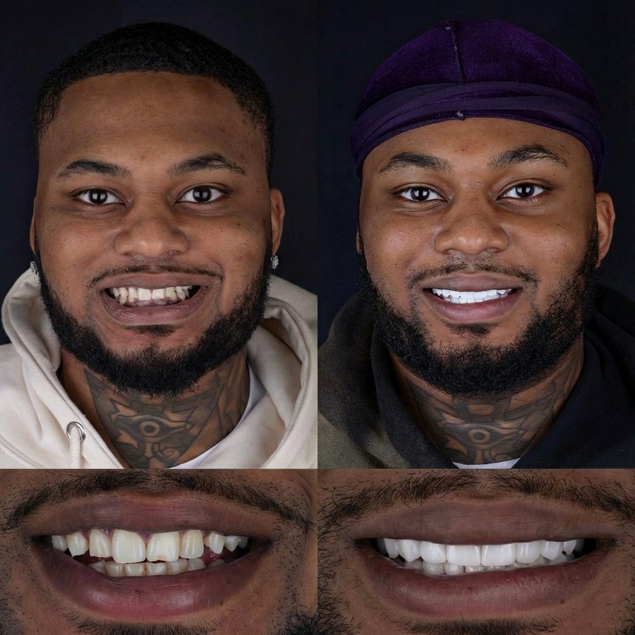 Smile design with Porcelain Veneers