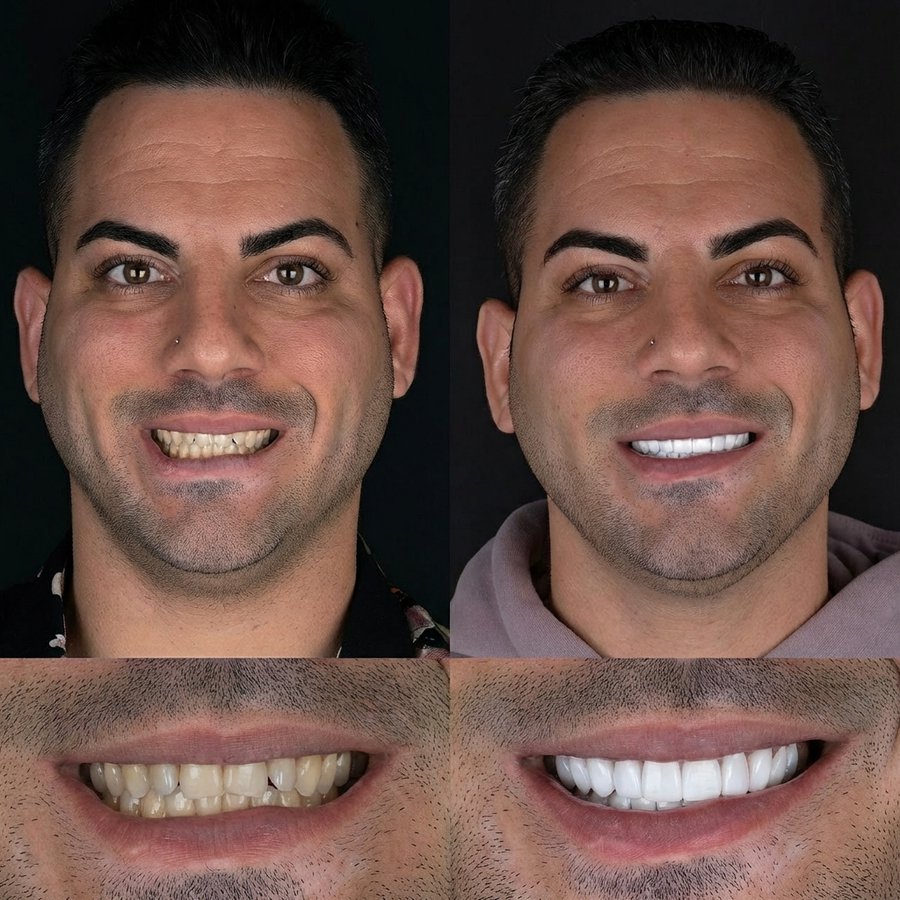 Smile design with Porcelain Veneers