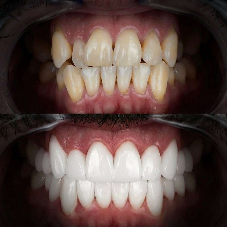 Smile design with Porcelain Veneers