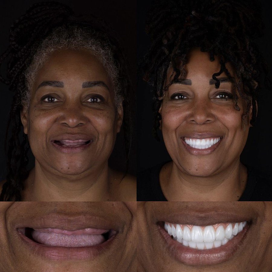 Hybrid Denture (top and bottom arch)