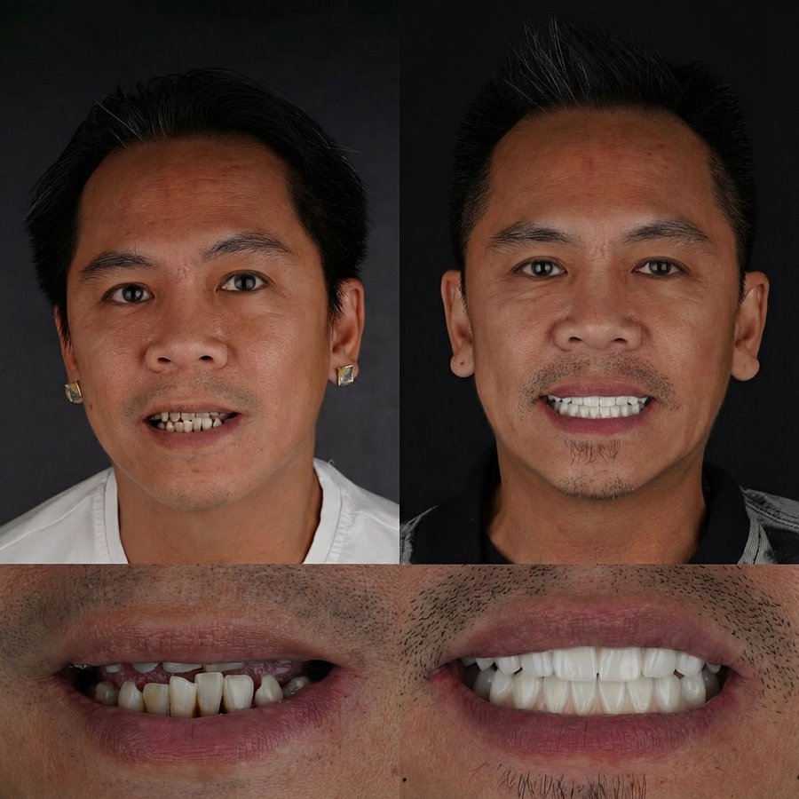 Hybrid Dentures (top and bottom)