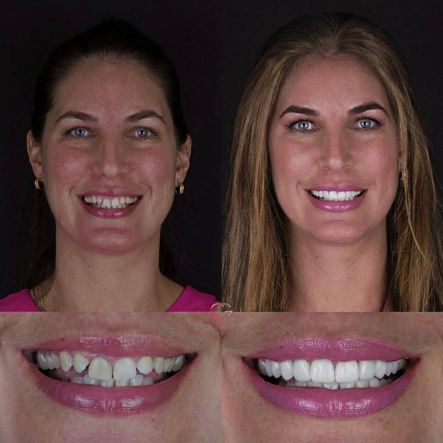 Smile design with Porcelain Veneers