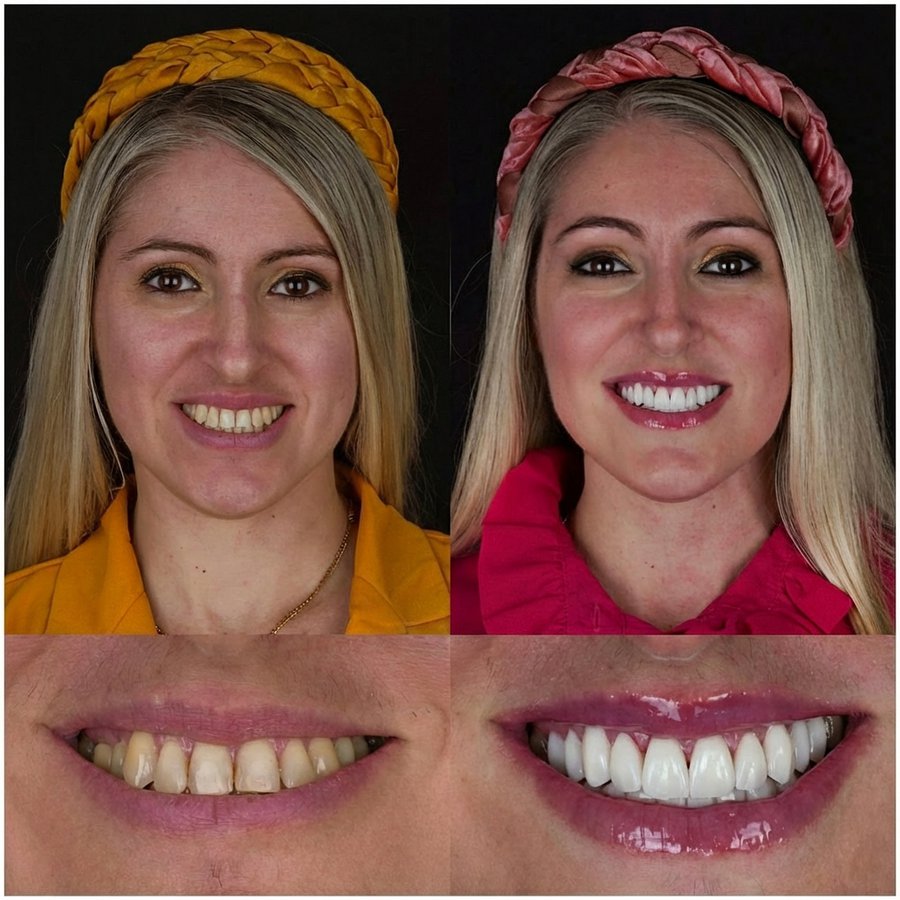 Smile design with Porcelain Veneers