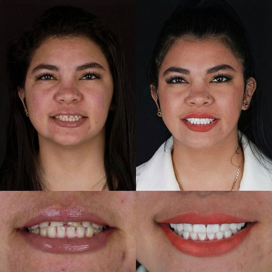 Smile design with Porcelain Veneers