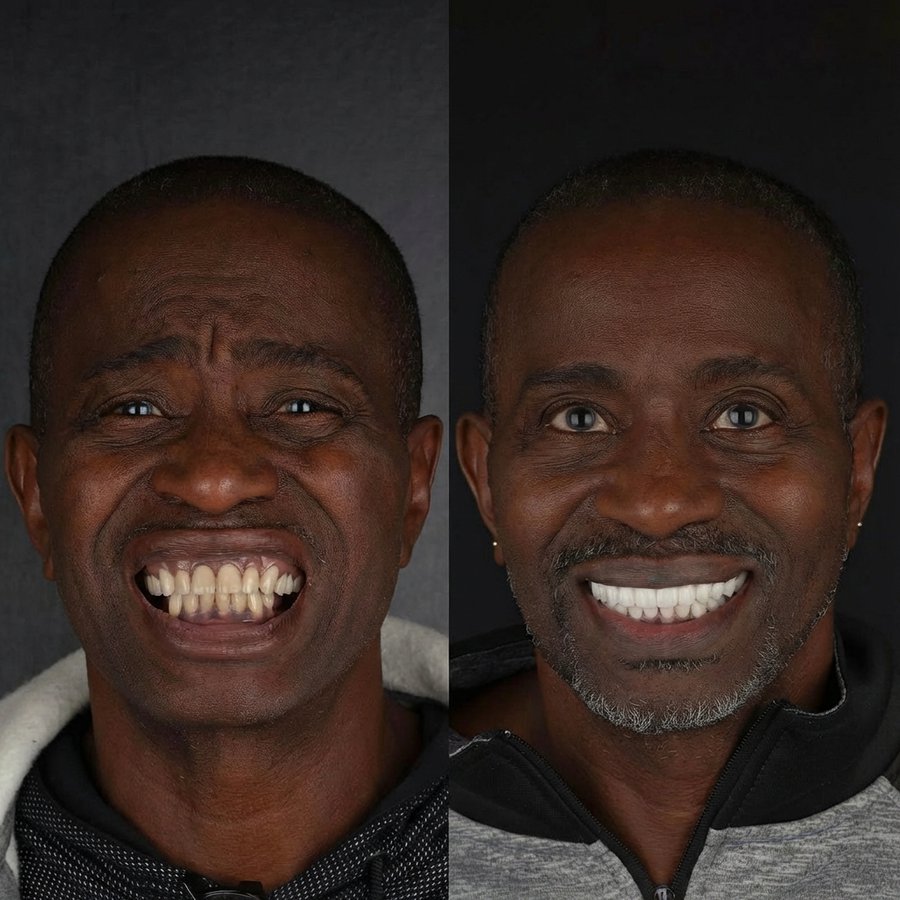 Hybrid Denture (top only) Porcelain Veneers (bottom)