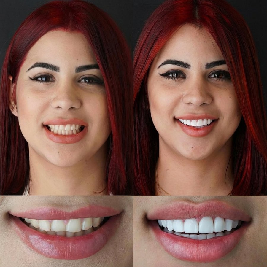 Smile design with Porcelain Veneers