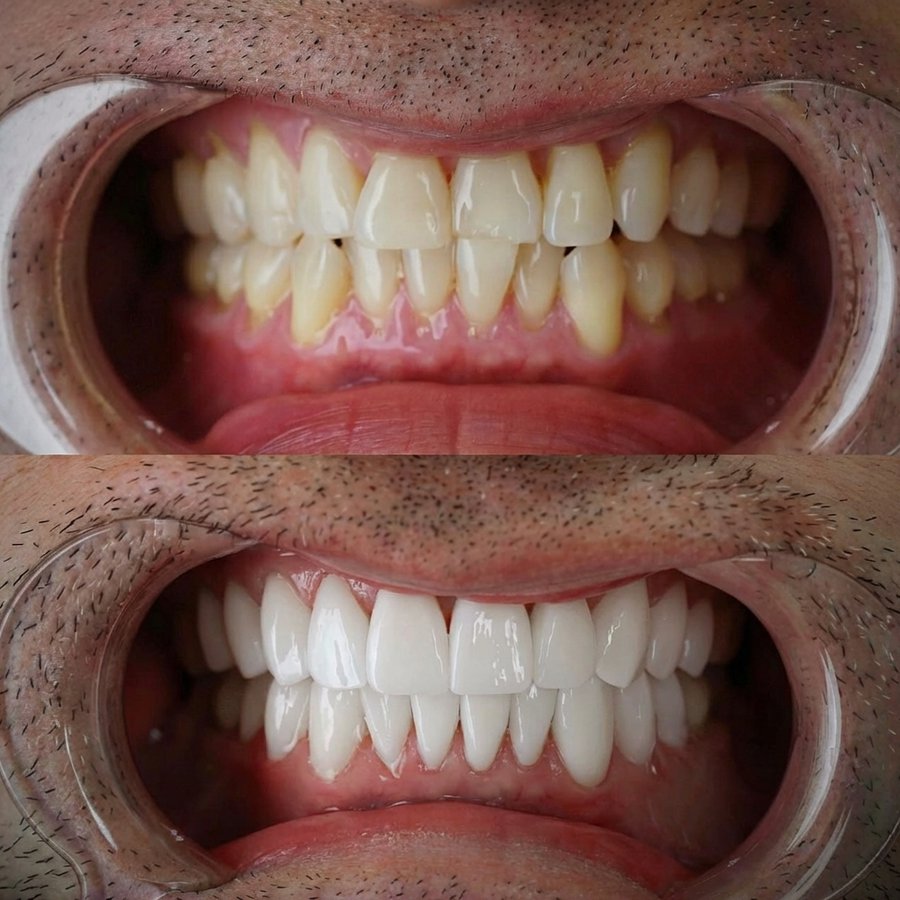 Smile design with Porcelain Veneers