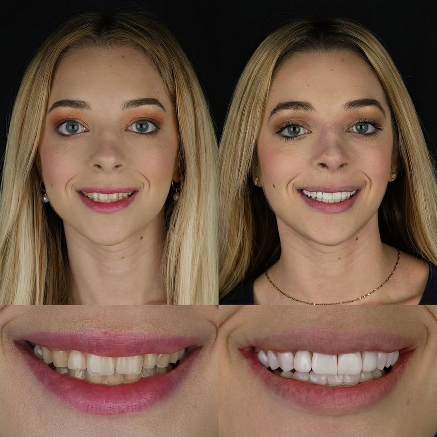 Smile design with Porcelain Veneers