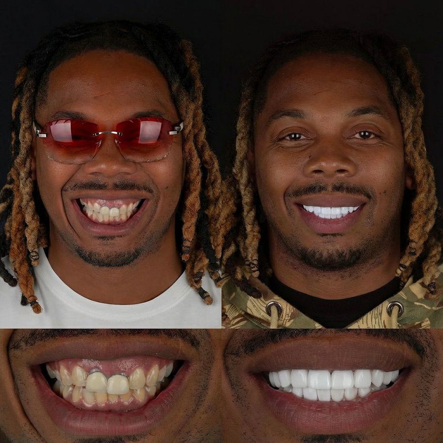 Smile design with Porcelain Veneers