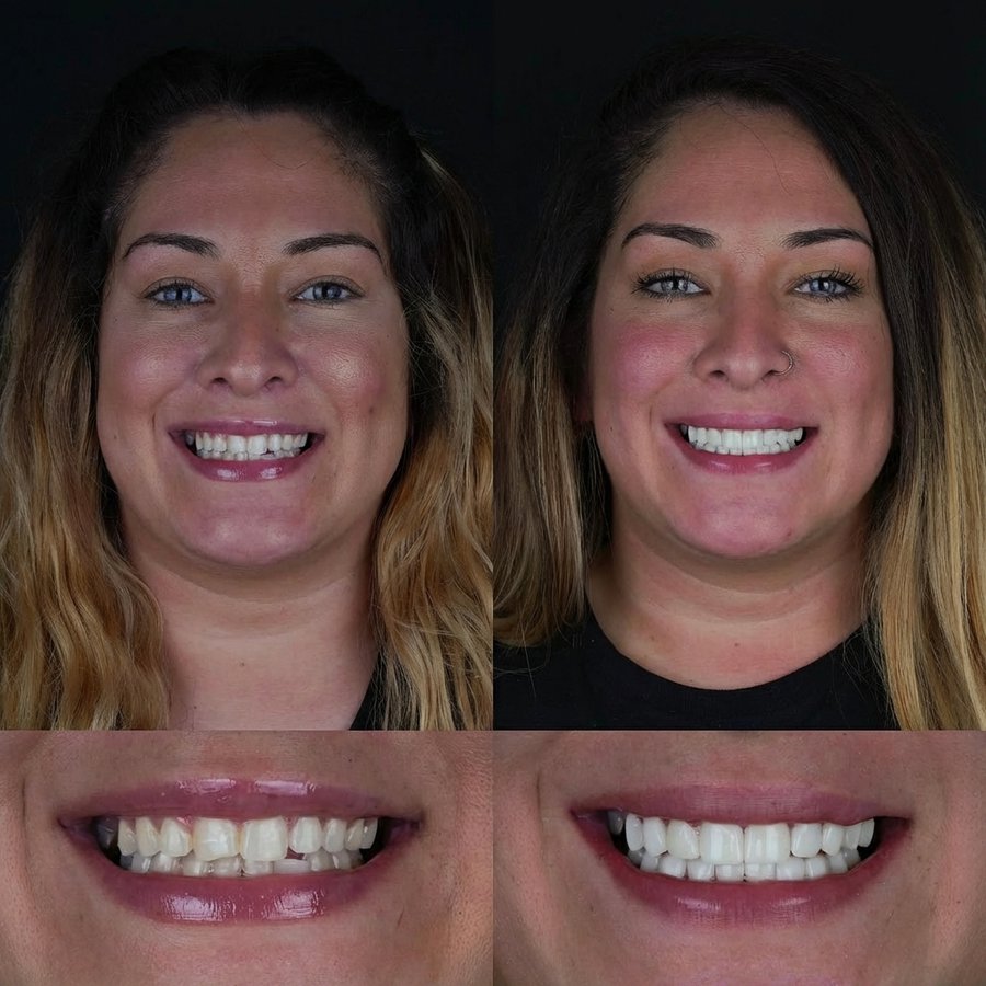 Smile design with Porcelain Veneers