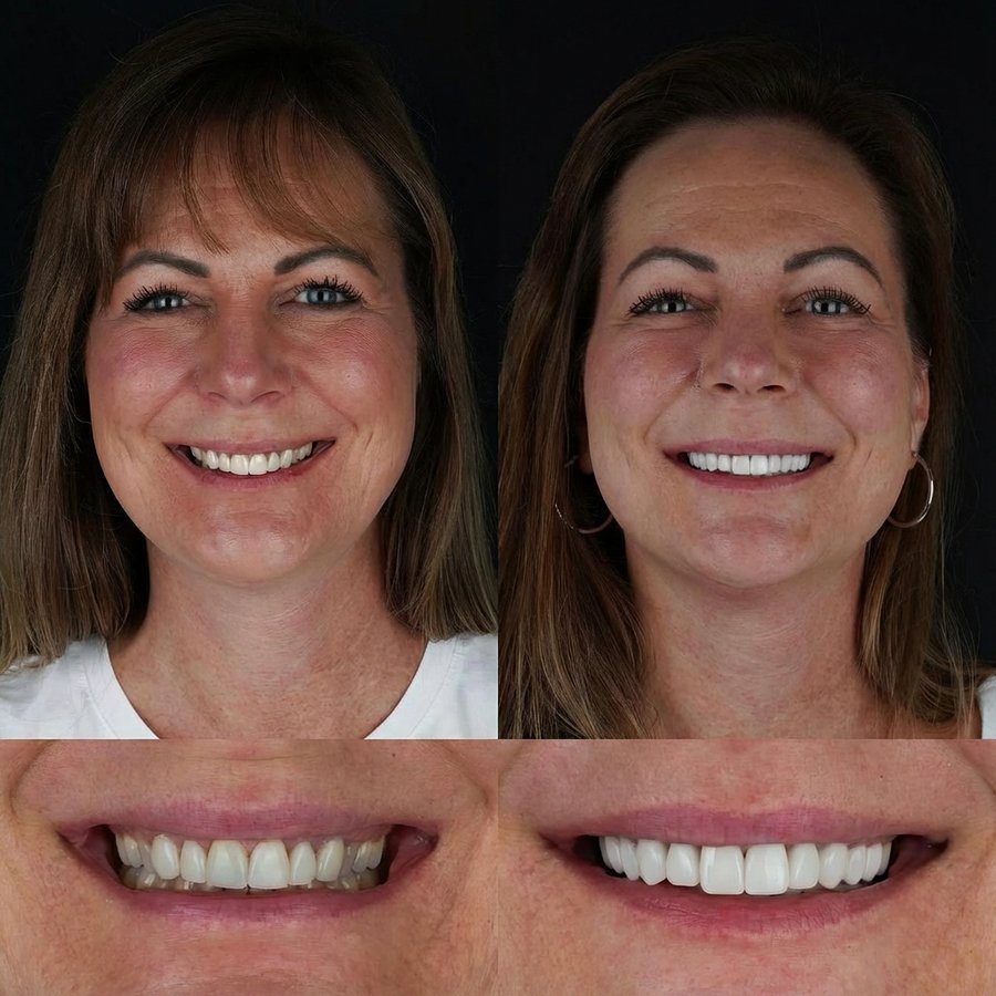 Smile design with Porcelain Veneers