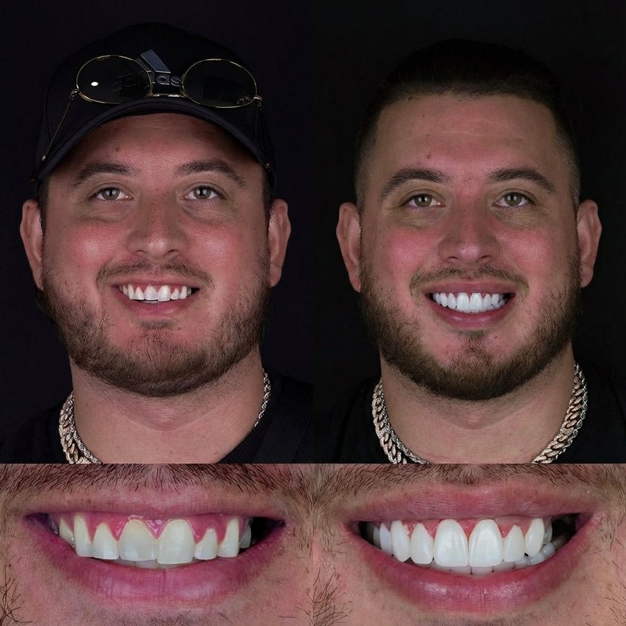 Smile design with Porcelain Veneers