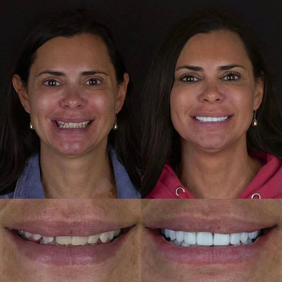 Smile design with Porcelain Veneers