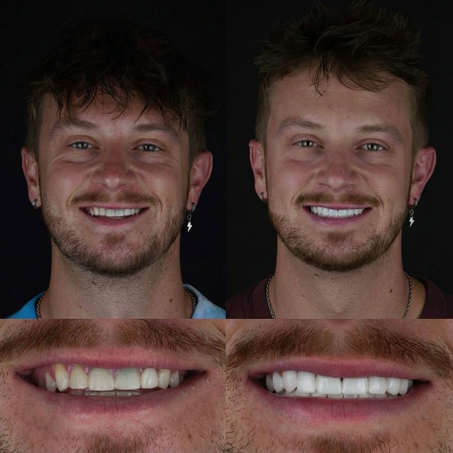 Smile design with Porcelain Veneers
