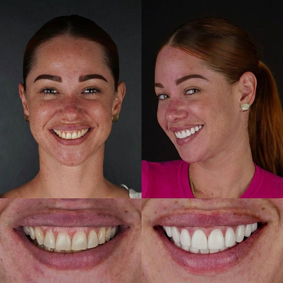 Smile design with Porcelain Veneers and Gingivectomy