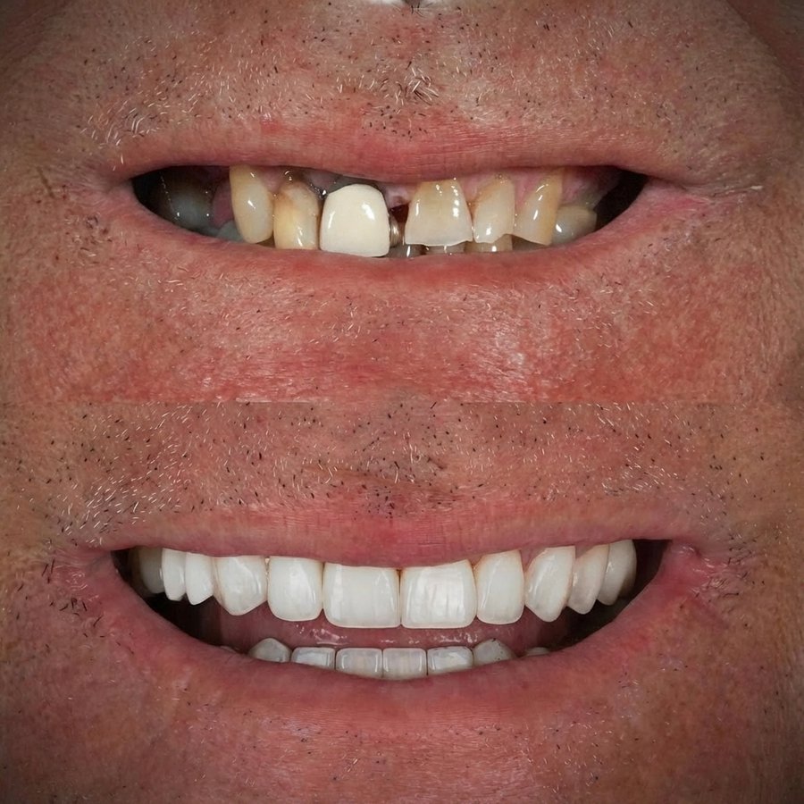 Smile design with Porcelain Veneers and Crown