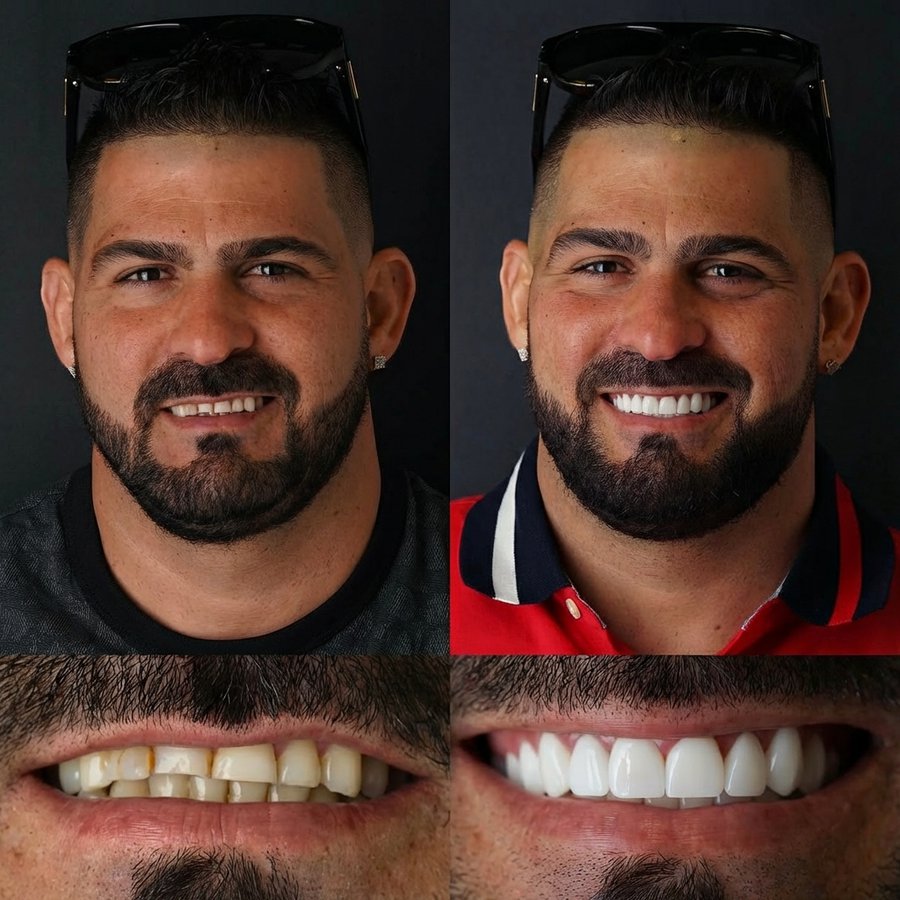 Smile design with Porcelain Veneers