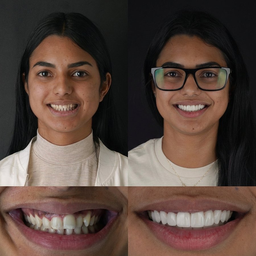 Smile design with Porcelain Veneers