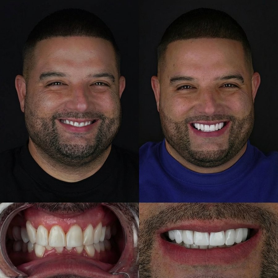 Smile design with Porcelain Veneers