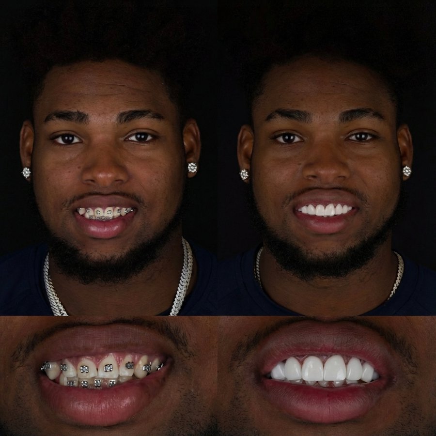 Smile design with Porcelain Veneers