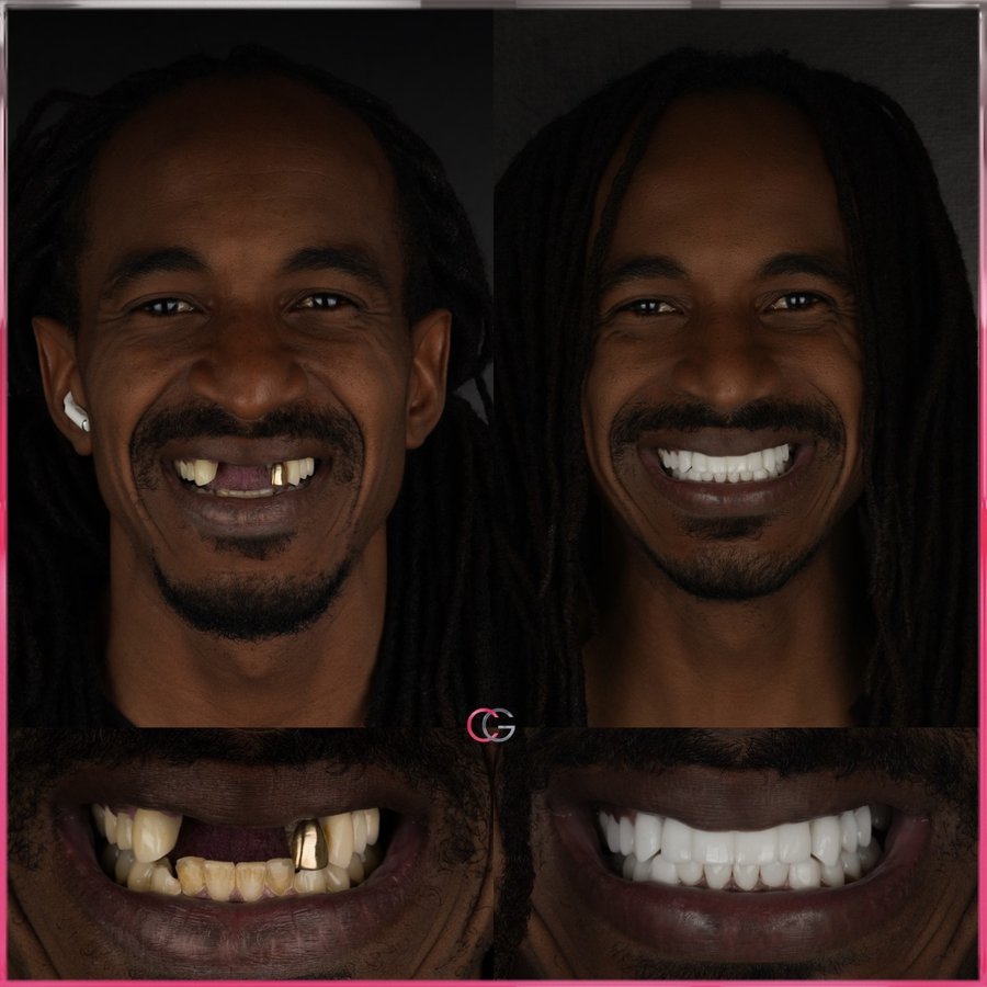 Smile design with Porcelain Veneers and Bridge