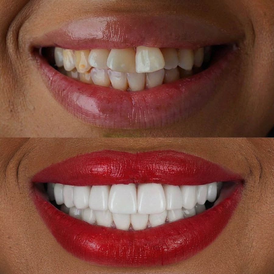 Smile design with Porcelain Veneers