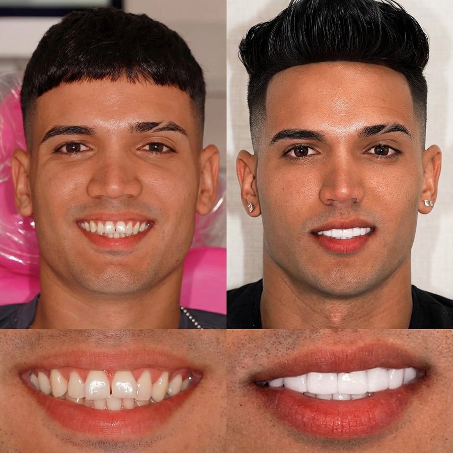 Smile design with Porcelain Veneers